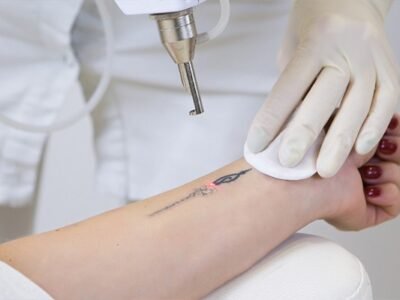 Laser Tattoo Removal – Safe & Effective Ink Removal