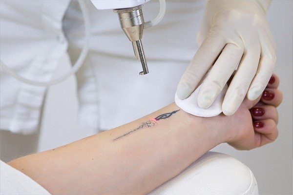 Laser Tattoo Removal – Safe & Effective Ink Removal